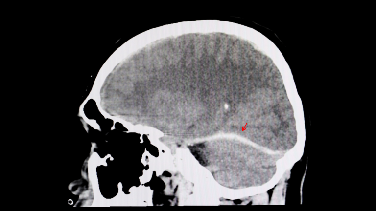 Brain